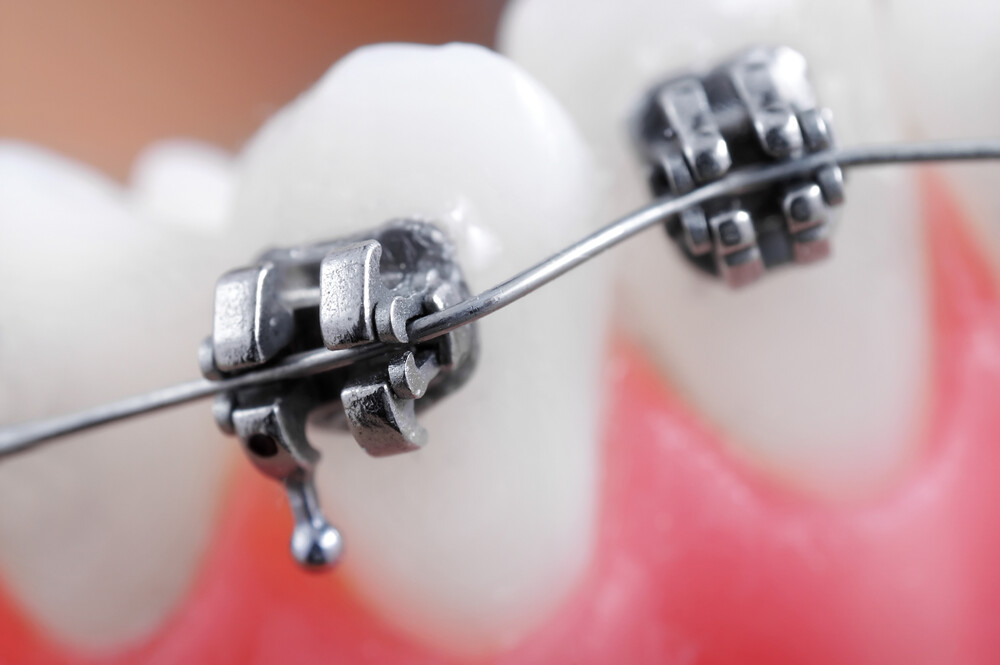 Dental braces super macro, crooked teeth, shallow depth of field